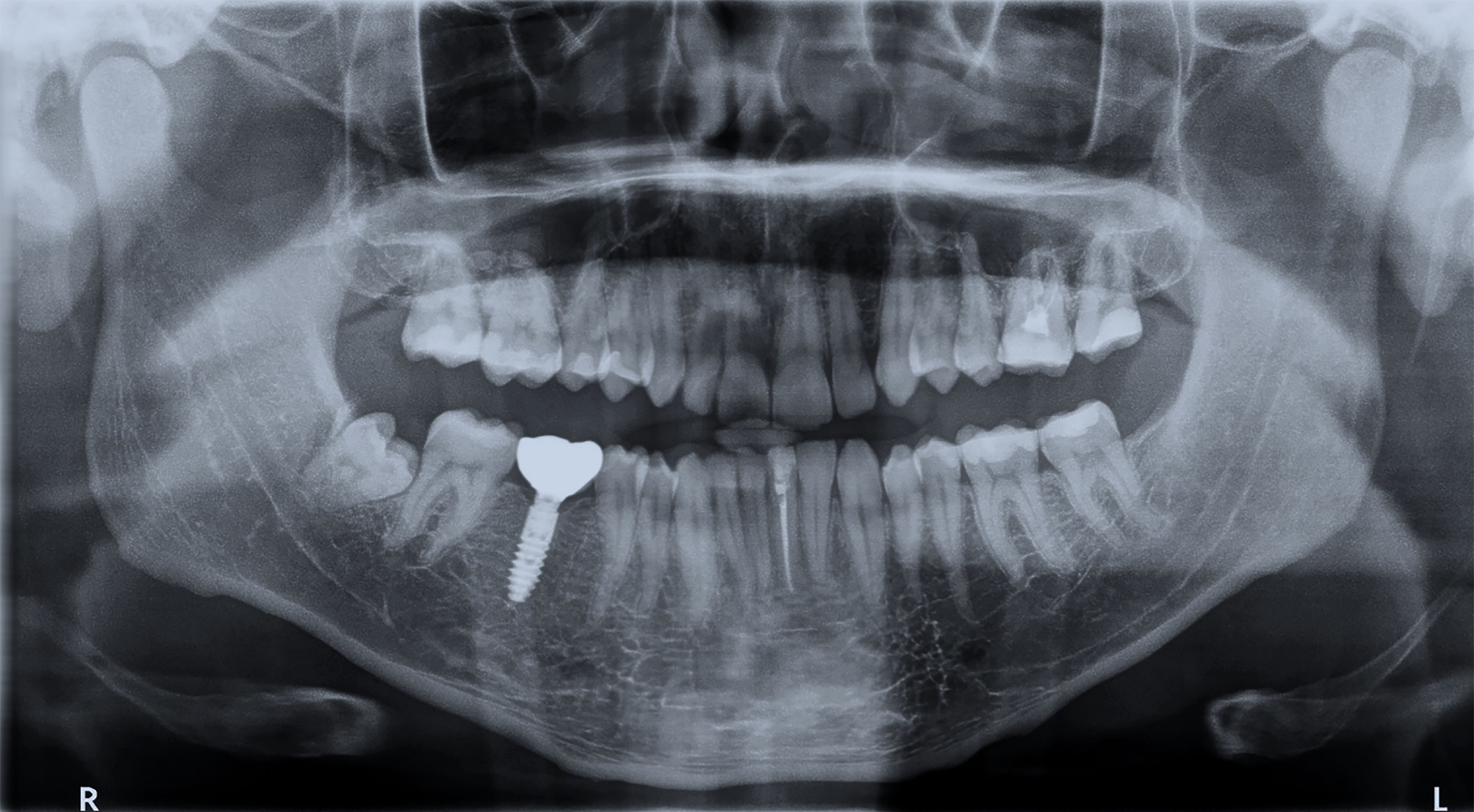 X-ray