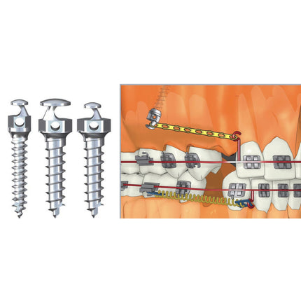 Absoanchor Golf Head 12mm Dia 1.8 