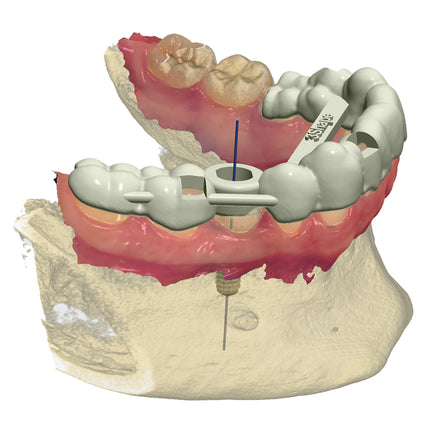 3Shape Implant Planner 
