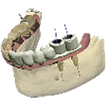3Shape Implant Studio Full Solution Stand Alone 
